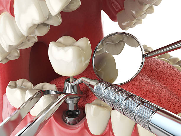 Best Emergency Dentist for Lost Fillings or Crowns in El Rio, CA